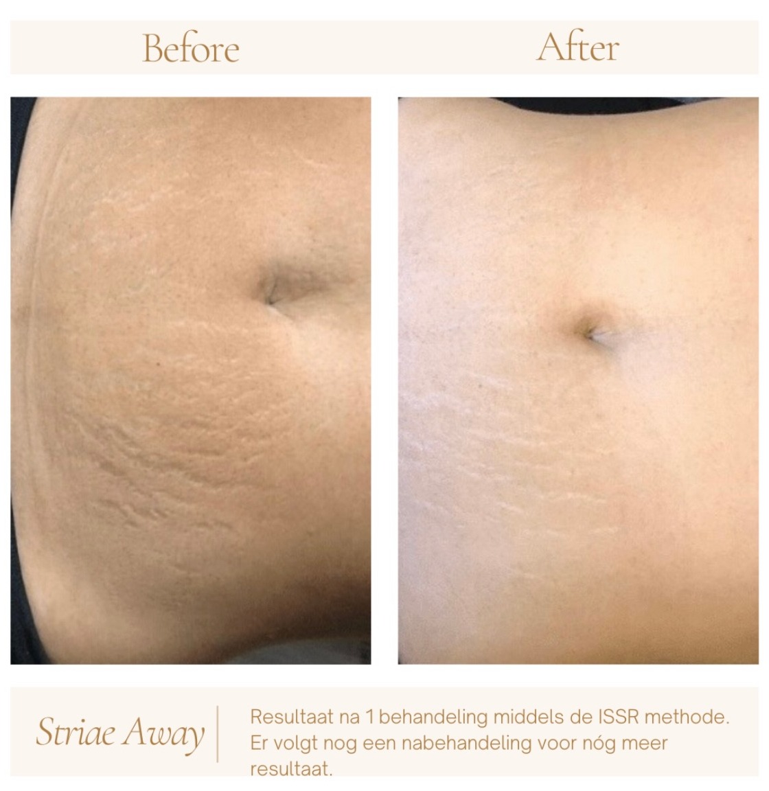 Voor en na: striae rond de navel, links voor en rechts na één behandeling