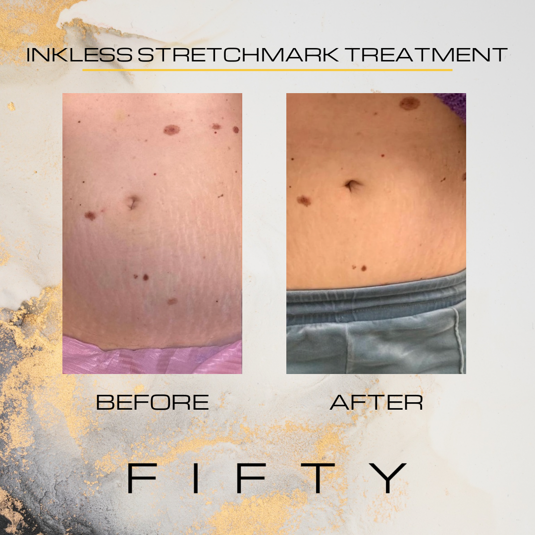 Voor en na: striae op de buik, links voor en rechts na de inkless stretchmark treatment, met het FIFTY logo